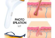 ازالة الشعر بالليزر