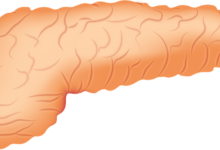 علاج التهاب البنكرياس المزمن